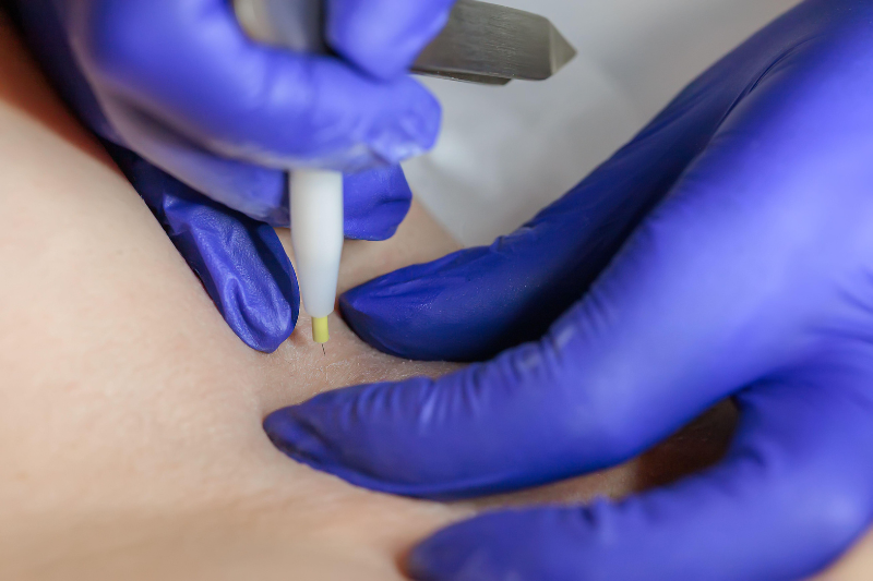 Depilación Electrodepilación Apilus XCell en Boadilla del Monte