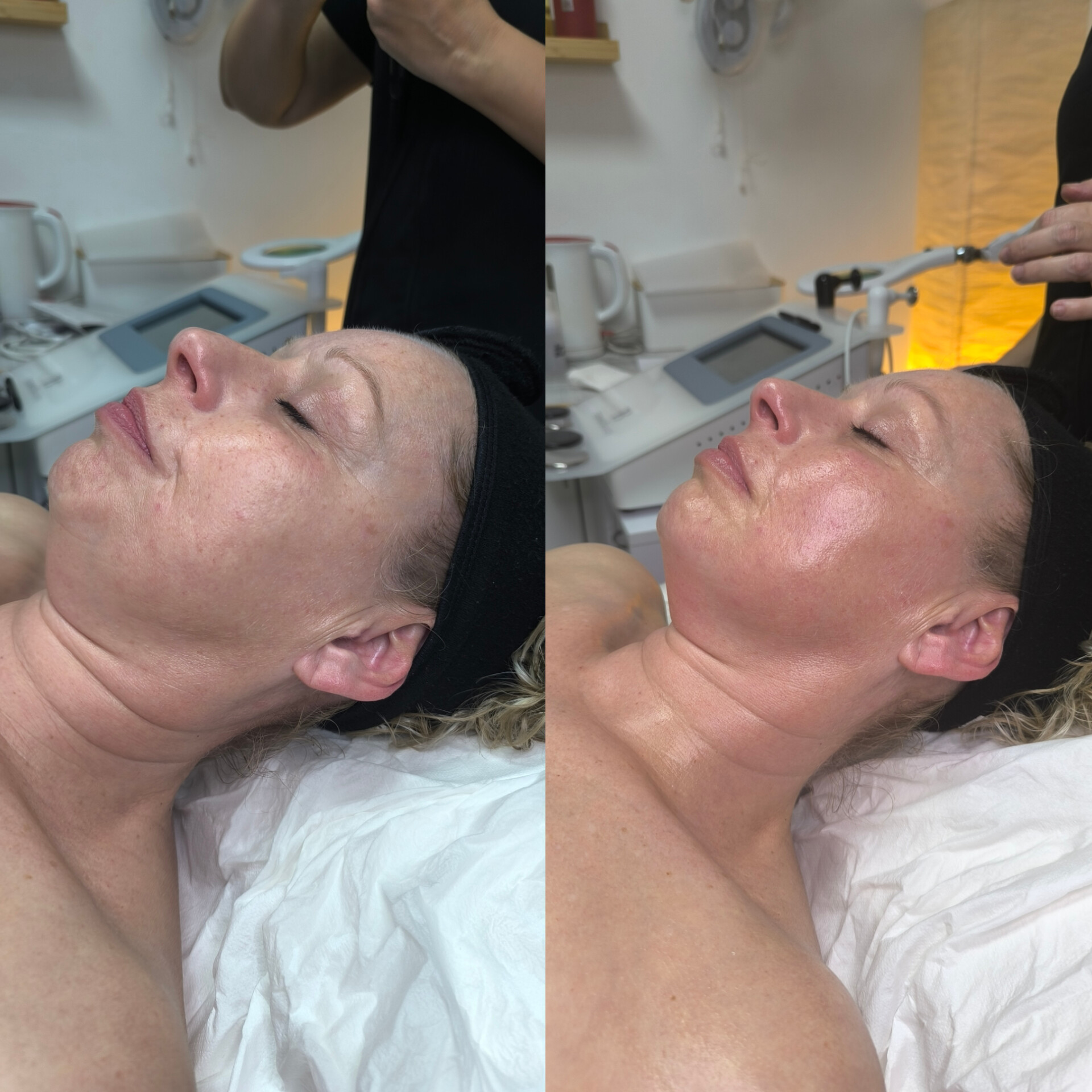 RF Termobeauty Facial en Boadilla del Monte